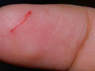 Tử vong sau 5 ngày vì một vết xước nhỏ ở tay khi làm vườn