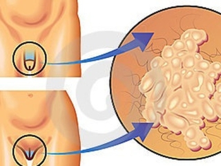 Trước khi oralsex hãy nghĩ đến căn bệnh ung thư nguy hiểm này