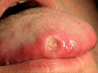 Lười vệ sinh răng miệng, nhiều người sững sờ khi mắc căn bệnh phải cắt lưỡi