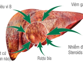 4 lời khuyên để tránh ung thư gan dành cho người hay uống rượu